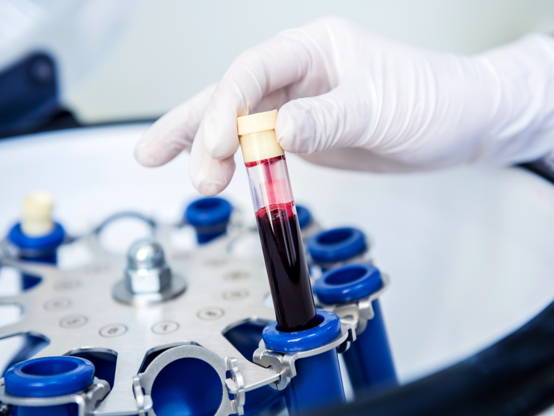 platelet-rich-plasma-preparation-tube-with-blood-hands